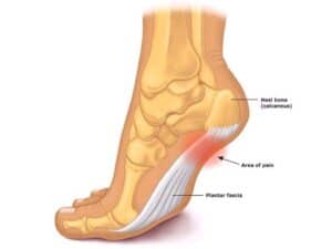 Read more about the article How To Fix Plantar Fasciitis