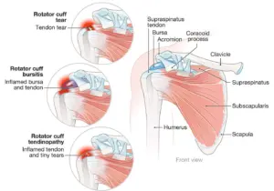 Read more about the article Management of Rotator Cuff Tears