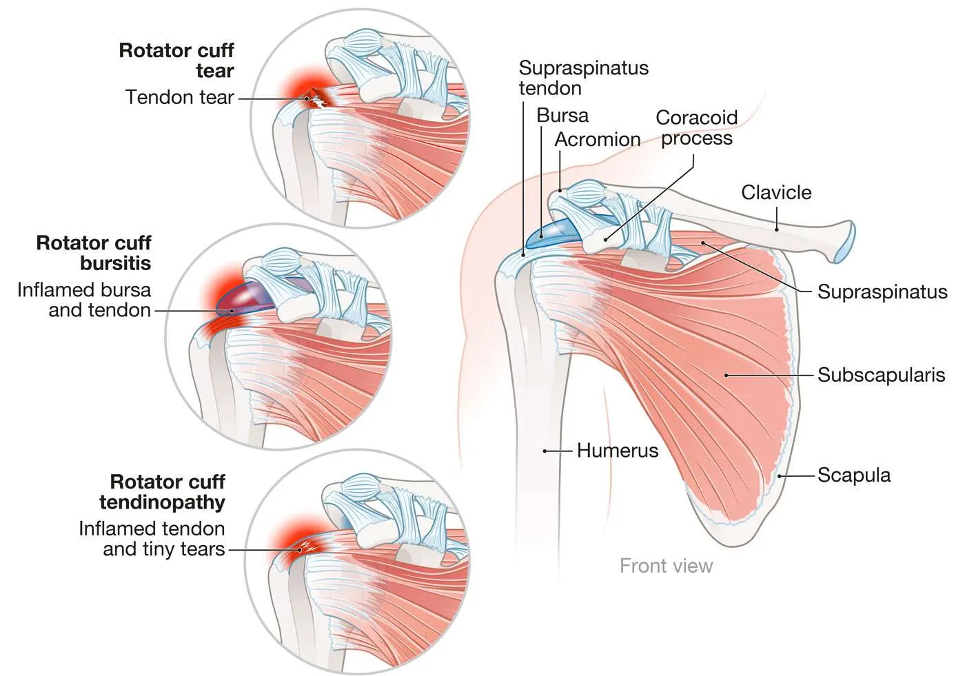 rotator cuff tear management hands in motion